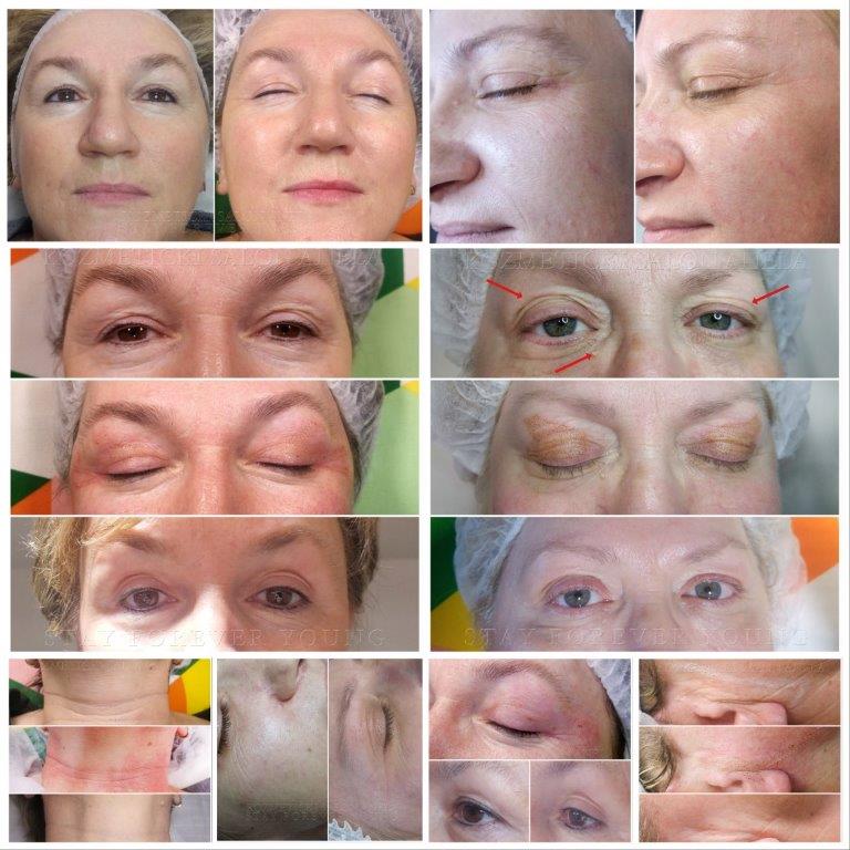 microneedling galerija